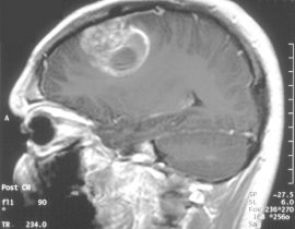 cannabinoidi trattamento oncologico