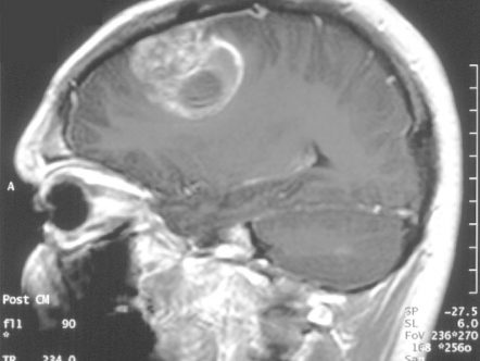 cannabinoidi trattamento oncologico