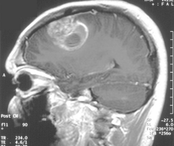 cannabinoidi trattamento oncologico