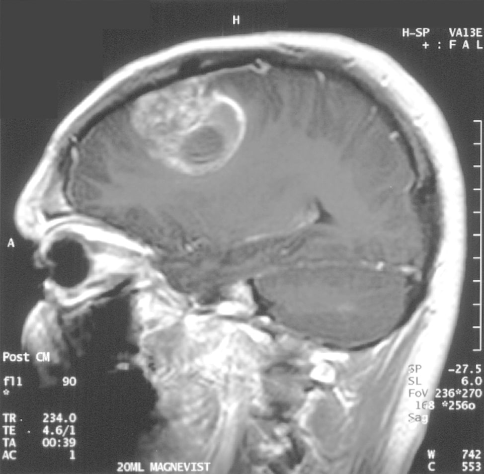 cannabinoidi trattamento oncologico